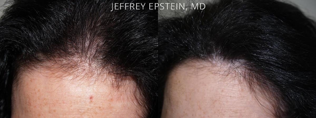 Hair Transplants for Women Before and after in Miami, FL, Paciente 41680