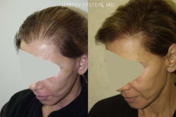 Trasplante de Pelo en Mujeres Before and after in Miami, FL, Paciente 101326