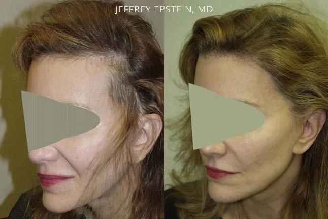 Hair Transplants for Women Before and after in Miami, FL, Paciente 41704