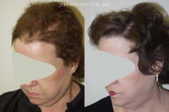 Hair Transplants for Women Before and after in Miami, FL, Paciente 41707