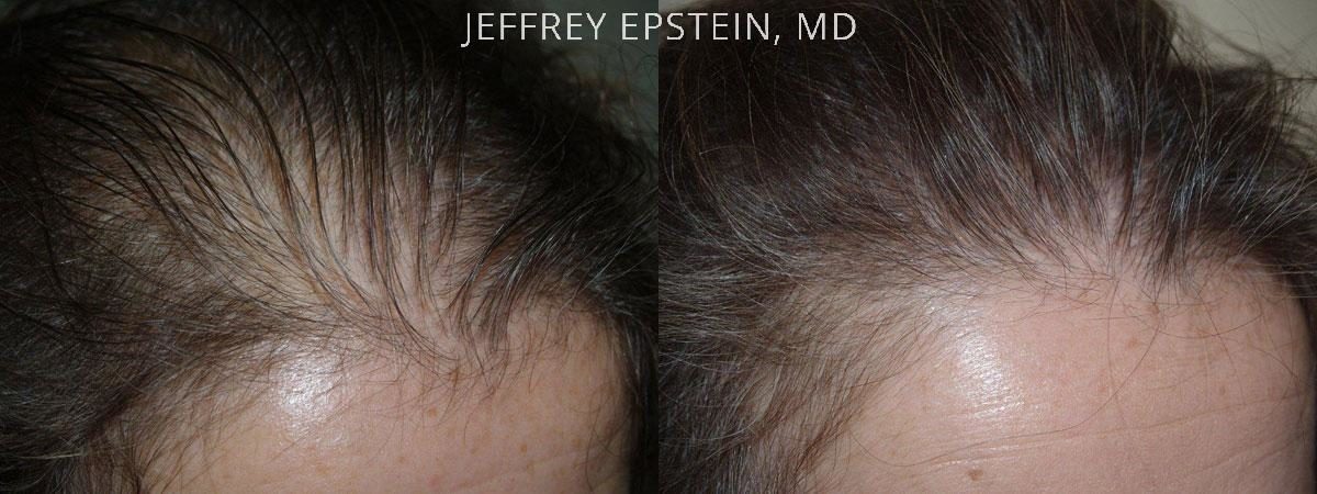Hair Transplants for Women Before and after in Miami, FL, Paciente 41719