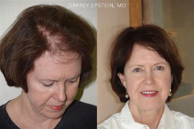 Hair Transplants for Women Before and after in Miami, FL, Paciente 41755
