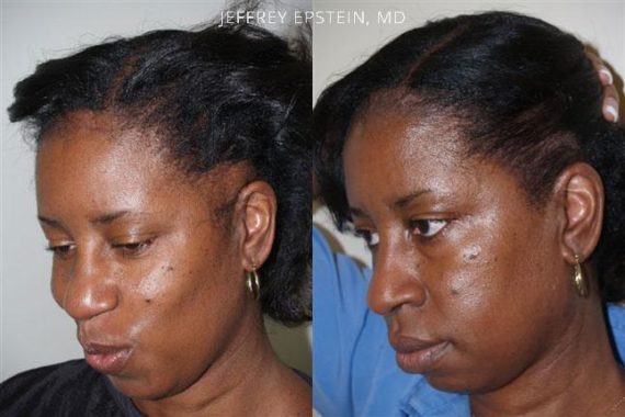 Trasplante de Pelo en Mujeres Before and after in Miami, FL, Paciente 101023