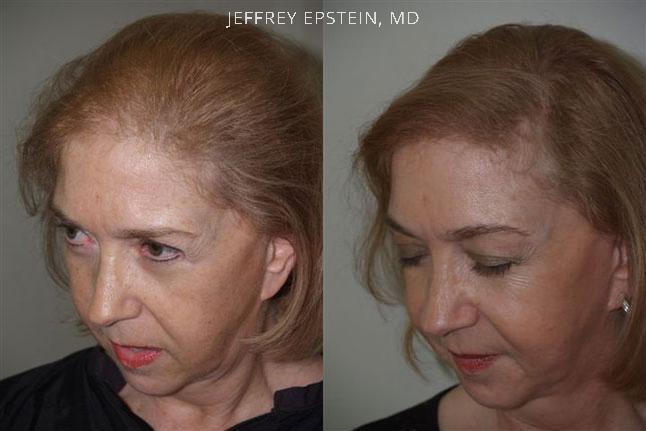 Hair Transplants for Women Before and after in Miami, FL, Paciente 41771