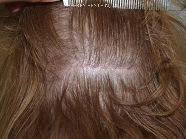 Hair Transplants for Women Before and after in Miami, FL, Paciente 41771