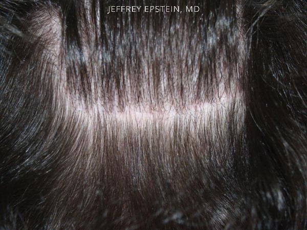 Hair Transplants for Women Before and after in Miami, FL, Paciente 41789