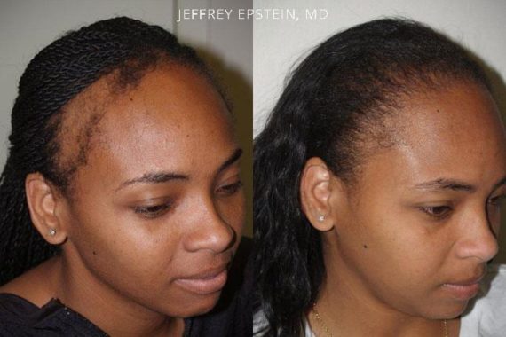 Hair Transplants for Women Before and after in Miami, FL, Paciente 41802