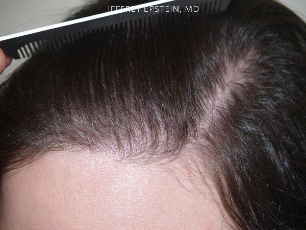 Hair Transplants for Women Before and after in Miami, FL, Paciente 41814