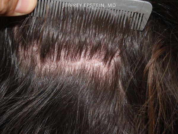 Hair Transplants for Women Before and after in Miami, FL, Paciente 41814