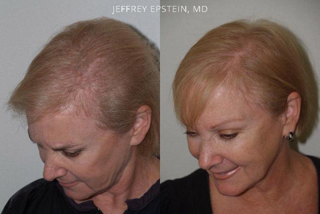 Hair Transplants for Women Before and after in Miami, FL, Paciente 41827