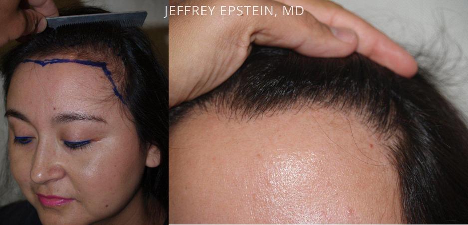 Hair Transplants for Women Before and after in Miami, FL, Paciente 41831
