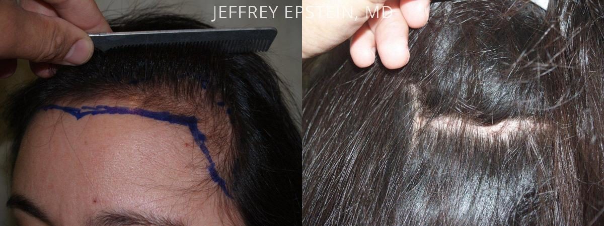 Hair Transplants for Women Before and after in Miami, FL, Paciente 41831