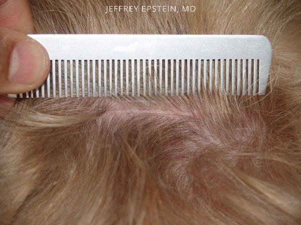 Hair Transplants for Women Before and after in Miami, FL, Paciente 41840