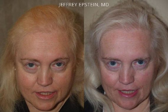 Hair Transplants for Women Before and after in Miami, FL, Paciente 41840