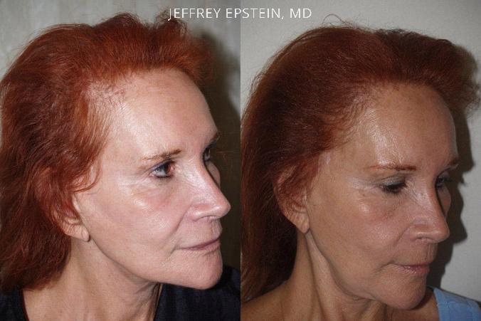 Hair Transplants for Women Before and after in Miami, FL, Paciente 41847