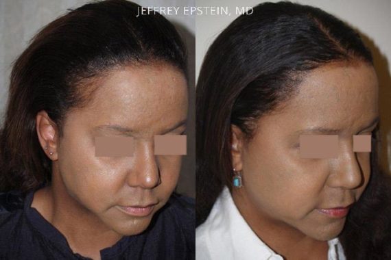 Trasplante de Pelo en Mujeres Before and after in Miami, FL, Paciente 100604