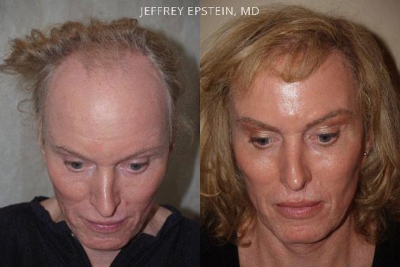 Casos Especiales Before and after in Miami, FL, Paciente 100534