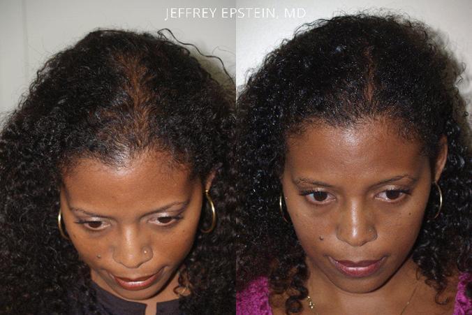 Hair Transplants for Women Before and after in Miami, FL, Paciente 41872