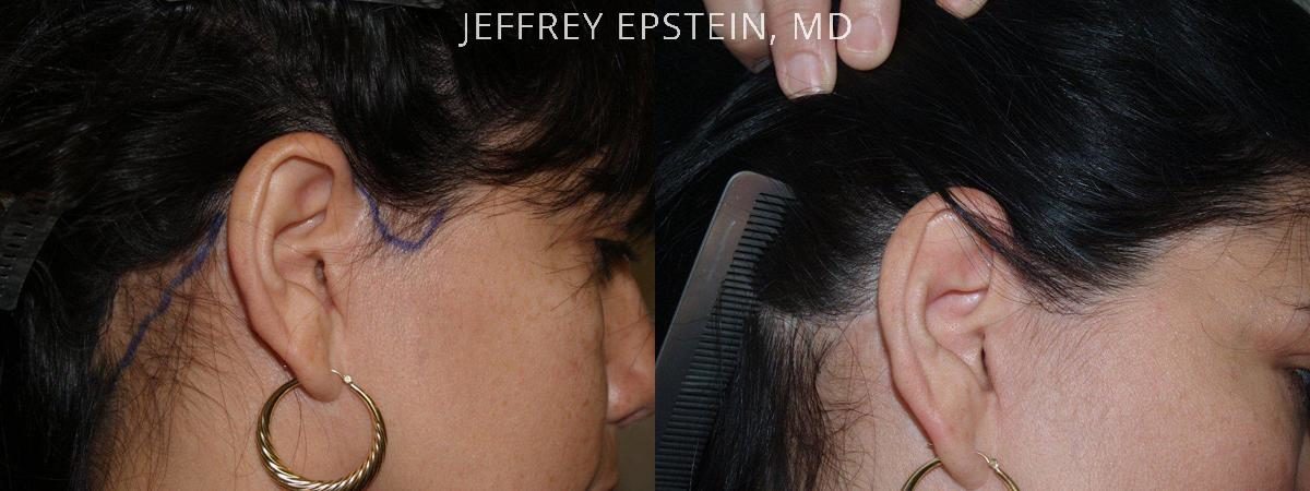 Hair Transplants for Women Before and after in Miami, FL, Paciente 41876