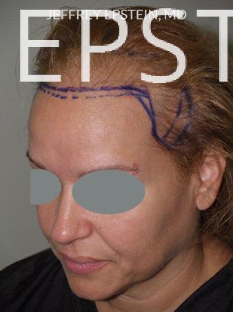 Hair Transplants for Women Before and after in Miami, FL, Paciente 41881