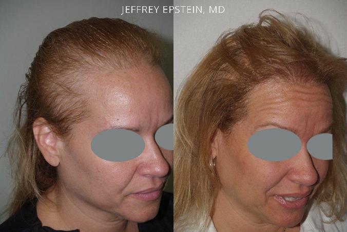 Hair Transplants for Women Before and after in Miami, FL, Paciente 41881