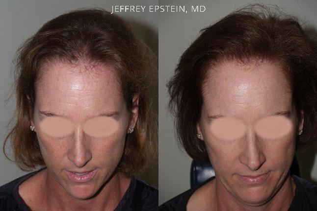 Hair Transplants for Women Before and after in Miami, FL, Paciente 41891