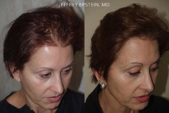 Hair Transplants for Women Before and after in Miami, FL, Paciente 41894