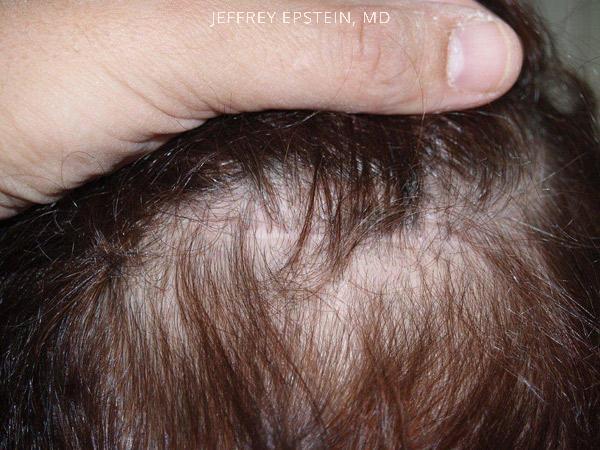 Hair Transplants for Women Before and after in Miami, FL, Paciente 41894