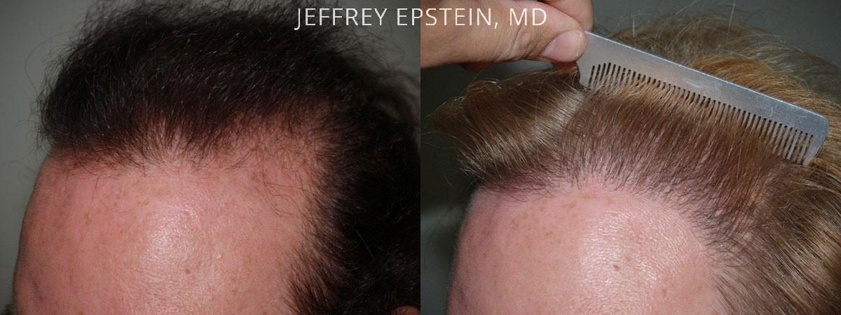 Hair Transplants for Women Before and after in Miami, FL, Paciente 41900