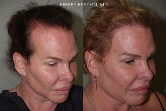 Hair Transplants for Women Before and after in Miami, FL, Paciente 41900