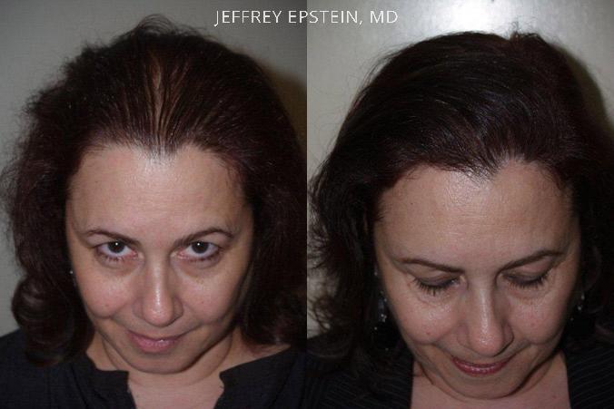 Hair Transplants for Women Before and after in Miami, FL, Paciente 41920