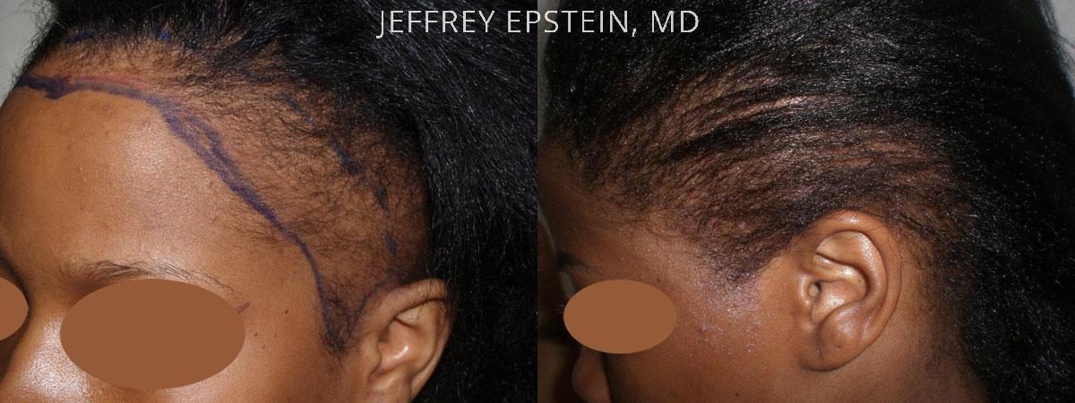 Hair Transplants for Women Before and after in Miami, FL, Paciente 41927
