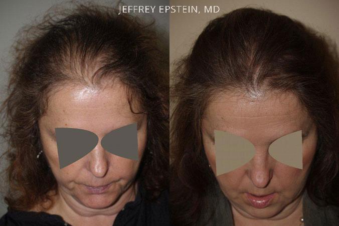 Hair Transplants for Women Before and after in Miami, FL, Paciente 41930