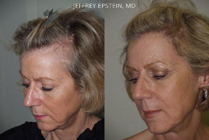 Hair Transplants for Women Before and after in Miami, FL, Paciente 41937