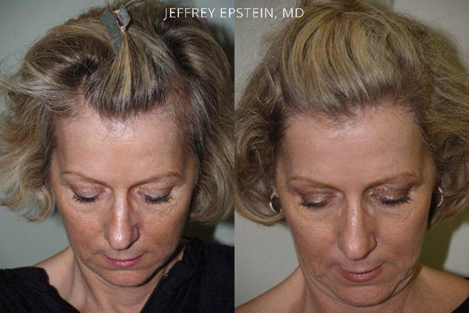 Hair Transplants for Women Before and after in Miami, FL, Paciente 41937