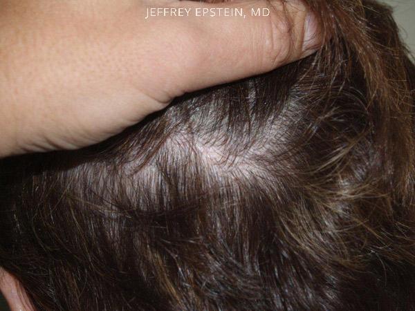 Hair Transplants for Women Before and after in Miami, FL, Paciente 41942