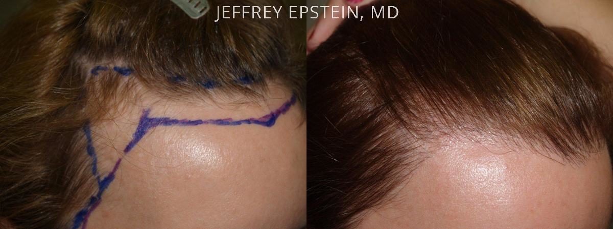 Hair Transplants for Women Before and after in Miami, FL, Paciente 41951