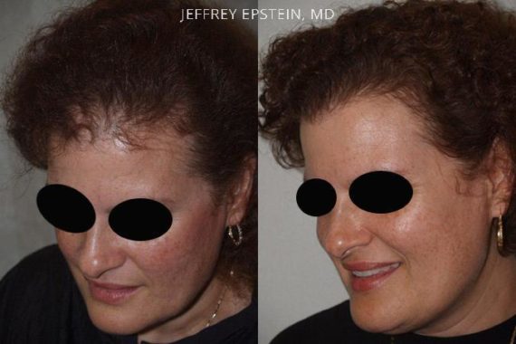 Trasplante de Pelo en Mujeres Before and after in Miami, FL, Paciente 100010