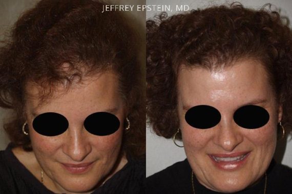 Trasplante de Pelo en Mujeres Before and after in Miami, FL, Paciente 100010