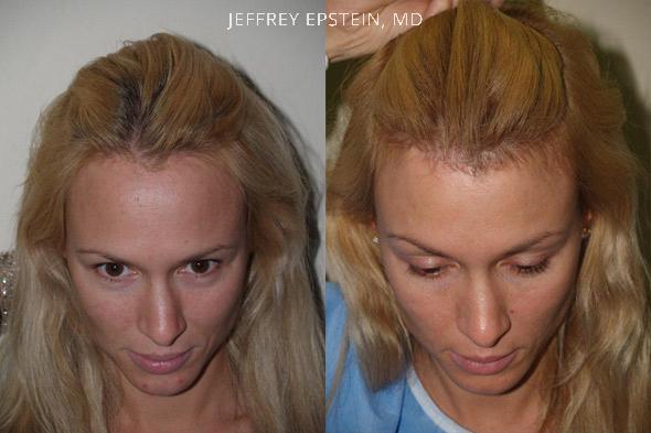 Hair Transplants for Women Before and after in Miami, FL, Paciente 41969