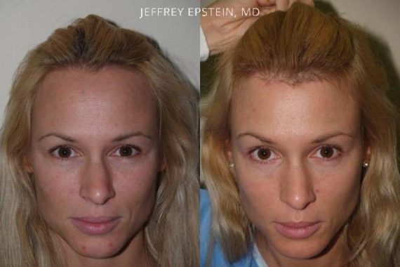 Hair Transplants for Women Before and after in Miami, FL, Paciente 41969