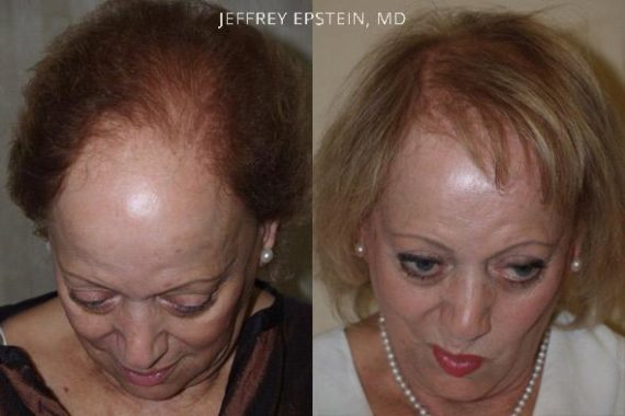Trasplante de Pelo en Mujeres Before and after in Miami, FL, Paciente 99869