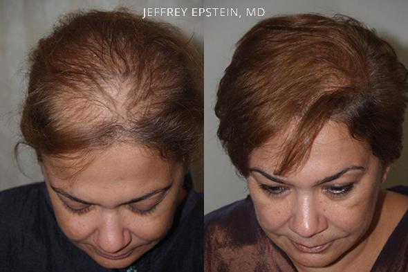  Before and after 1.650 grafts. 