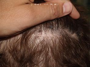 Hair Transplants for Women Before and after in Miami, FL, Paciente 42003