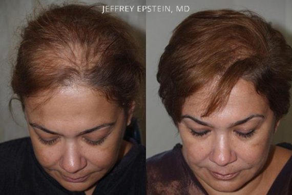 Hair Transplants for Women Before and after in Miami, FL, Paciente 42003