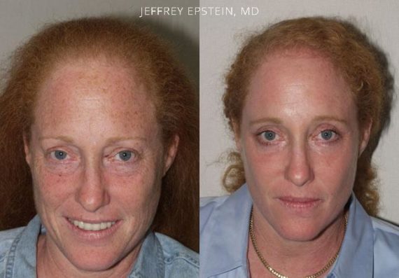 Hair Transplants for Women Before and after in Miami, FL, Paciente 42011