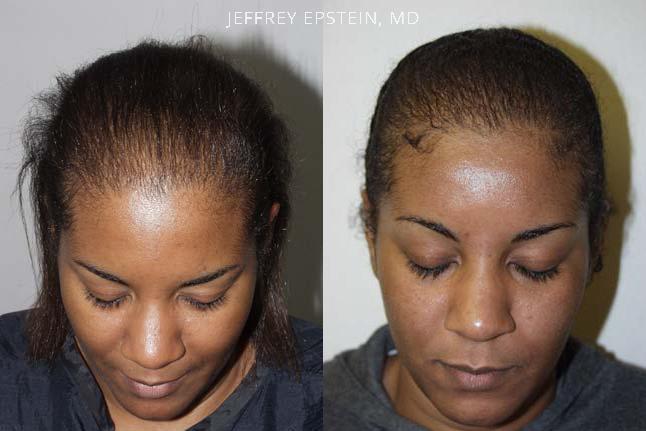 Hair Transplants for Women Before and after in Miami, FL, Paciente 42014