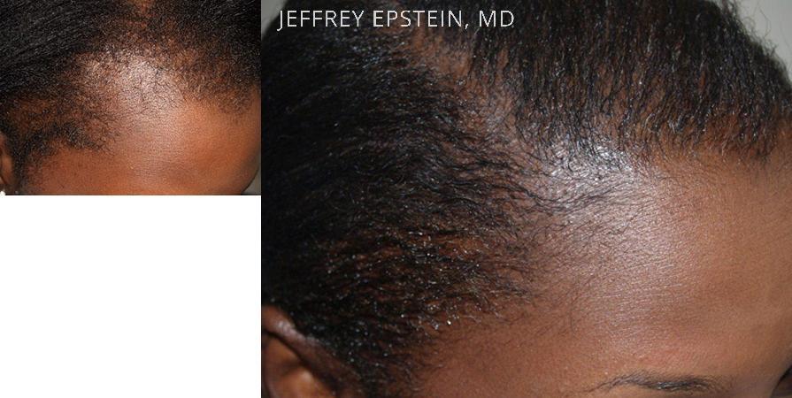 Hair Transplants for Women Before and after in Miami, FL, Paciente 42029