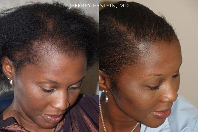 Hair Transplants for Women Before and after in Miami, FL, Paciente 42029