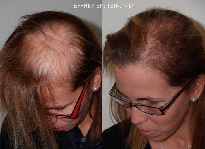 Hair Transplants for Women Before and after in Miami, FL, Paciente 42053